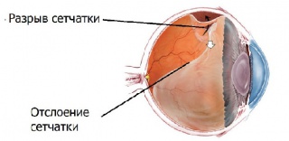 Разрыв сетчатки глаза
